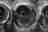 For Complex PCI, Intravascular Imaging Lowers Risk of Target Vessel Failure  